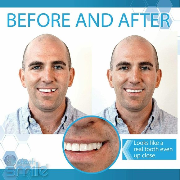Instant Smile Complete Your Smile Temporary Tooth Replacement Kit 40 Fake Teeth - Picture 6 of 7